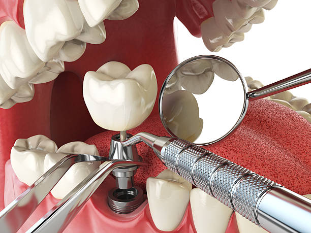 Tooth Infection Emergency Dentist in OH